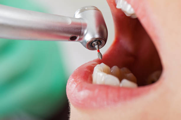 Best Dentist for Tooth Abscess  in Marlette, MI